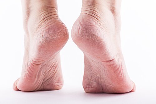 Calluses on the Feet