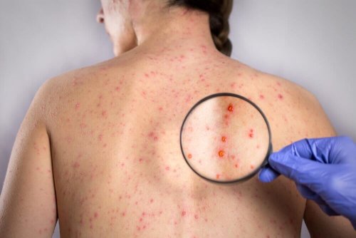 Herpes sores on the back