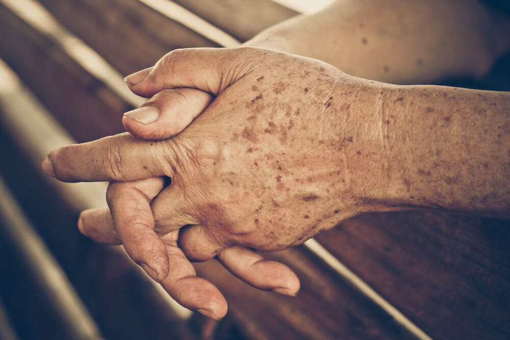 The 5 Best Remedies for Liver Spots