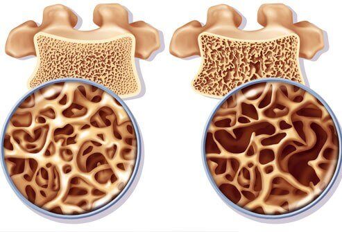 How to Prepare a Calcium-Rich Remedy to Prevent Osteoporosis