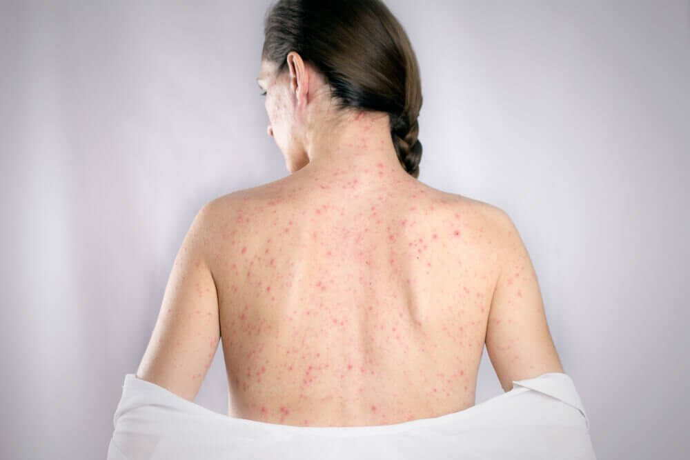 the-5-best-remedies-to-cure-back-herpes-step-to-health