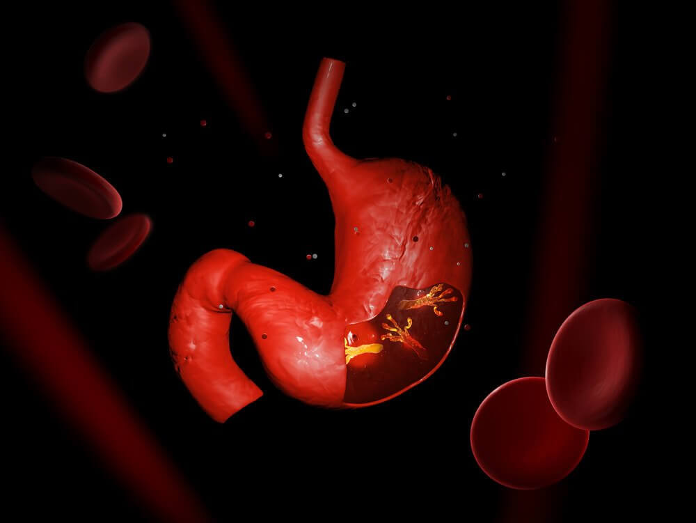 Herbal Remedies to Fight a Helicobacter Pylori Infection