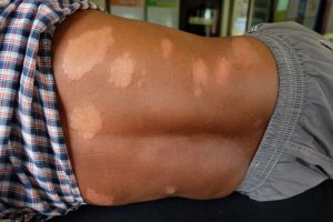 How to Relieve the Symptoms of Hansen's Disease Naturally