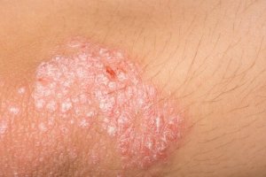Best Remedies to Treat Eczema