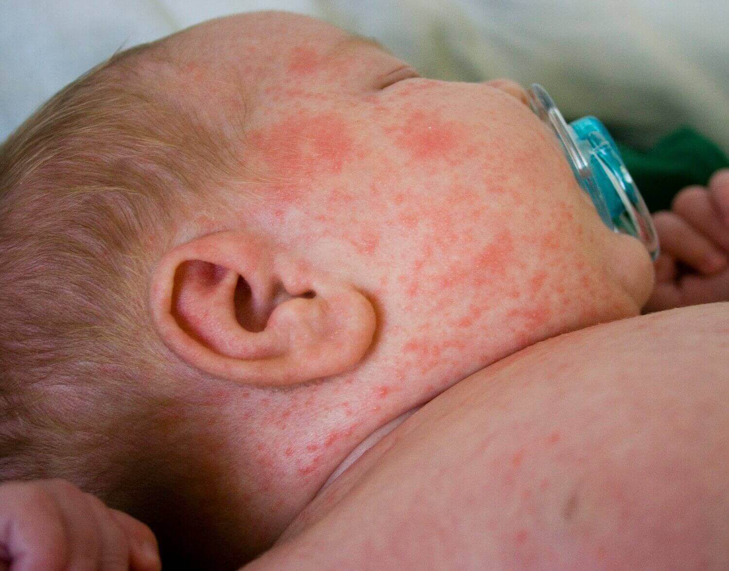Heat rash in babies.