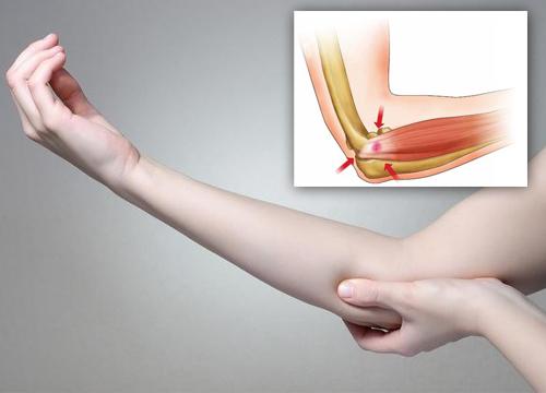 Relieve Your Tennis Elbow With These 5 Natural Remedies