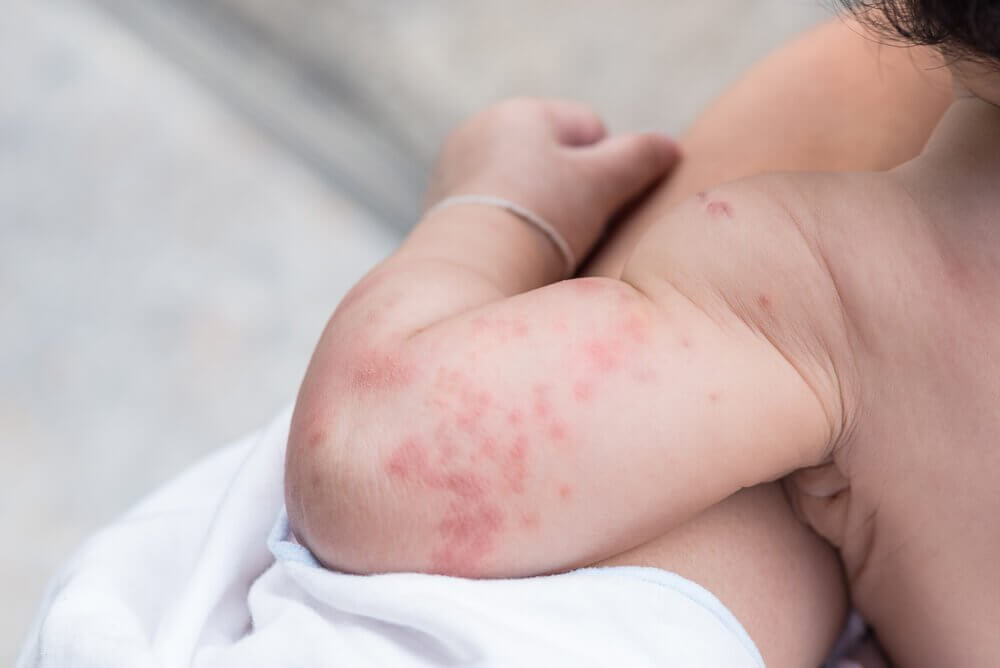 What to Do About Heat Rash in Babies: Should I Be Worried?