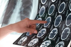 6 Tips to Help You Prevent a Stroke