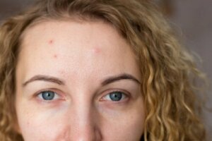 5 Symptoms of Polycystic Ovary Syndrome