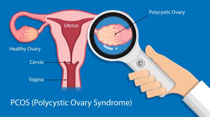 Natural Treatment for Polycystic Ovary Syndrome
