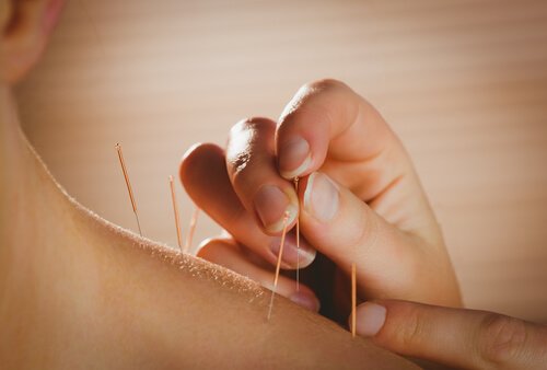 What are the Health Benefits of Acupuncture?
