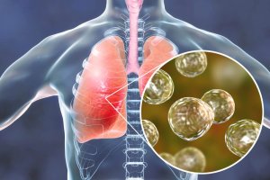 5 Natural Remedies for Blastomycosis Symptoms