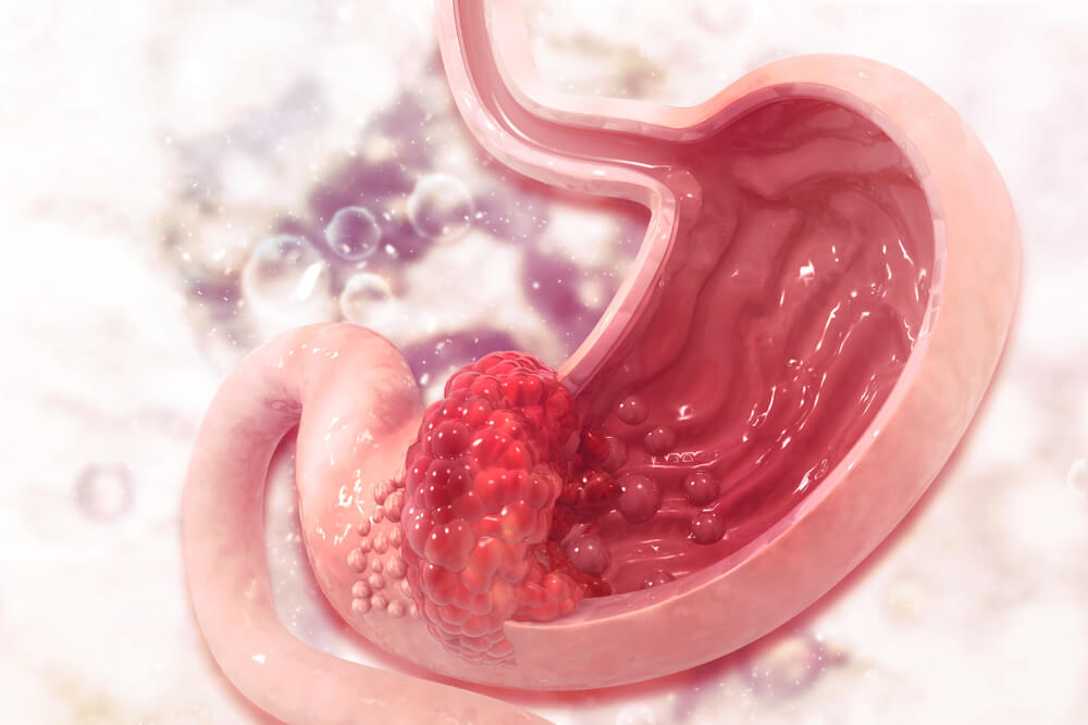 6 Foods You Should Eat If You Have Stomach Ulcers Step To Health