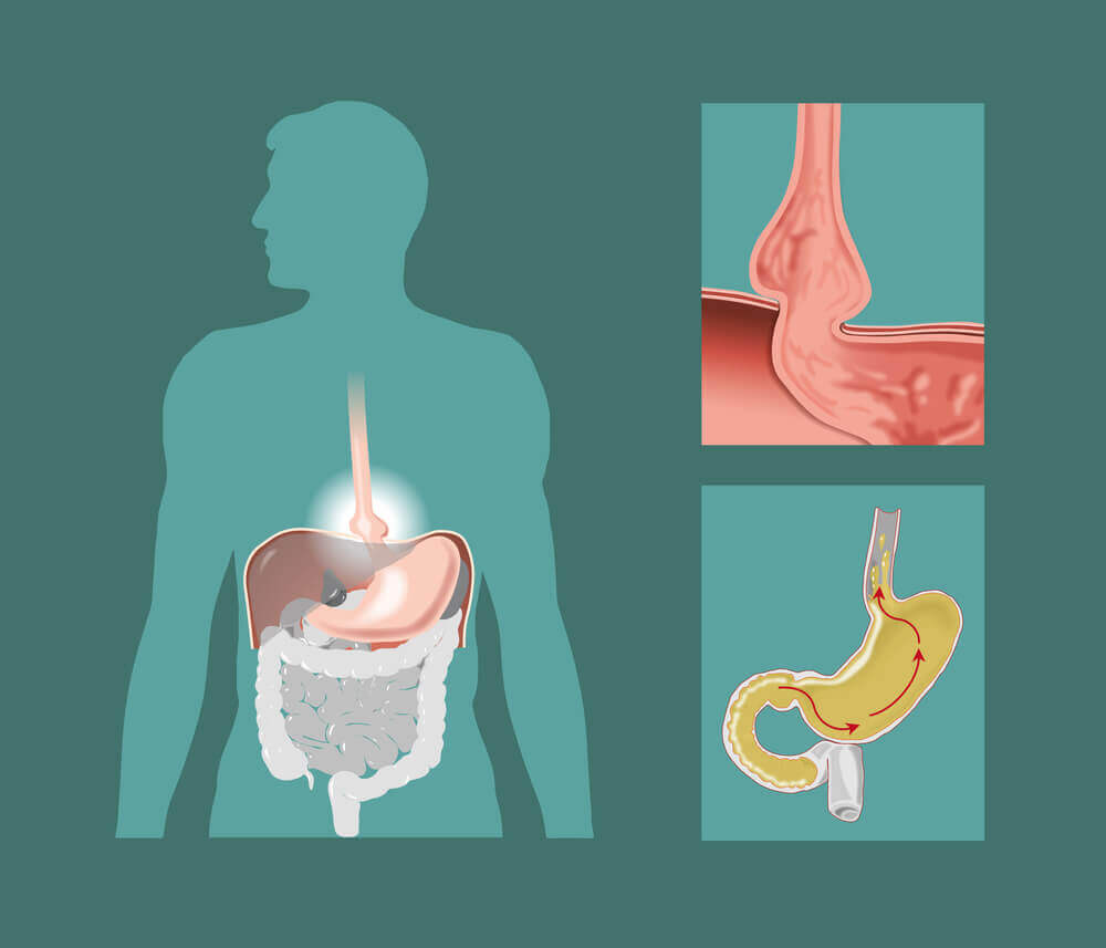 Hiatal Hernia Causes And Natural Remedies To Treat It Step To Health