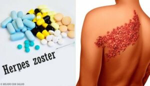 Top 5 Remedies to Treat Shingles on the Back