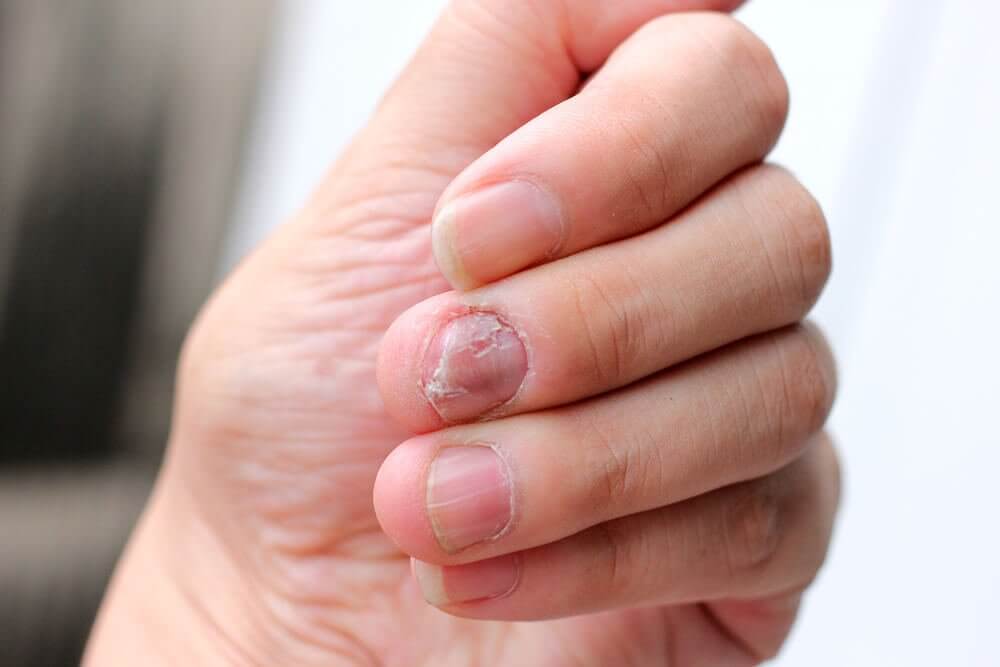 5 Natural Remedies for Psoriatic Nails