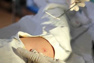 Can You Still Get Pregnant With a Progestin Implant?