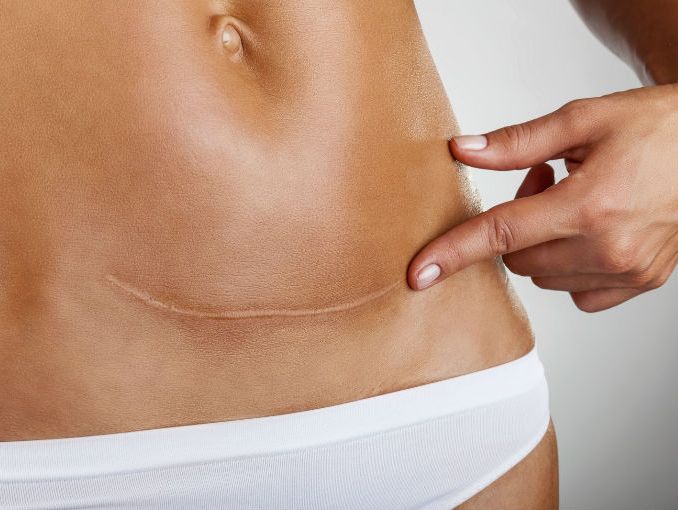A C-section scar.