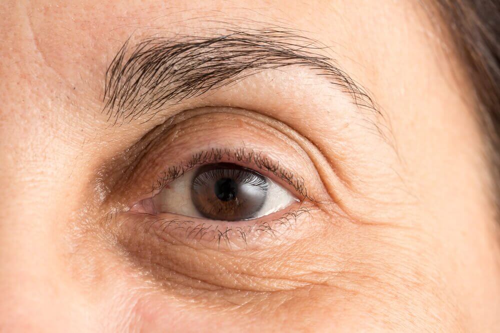 How to Minimize Dark Circles: 5 Natural Methods