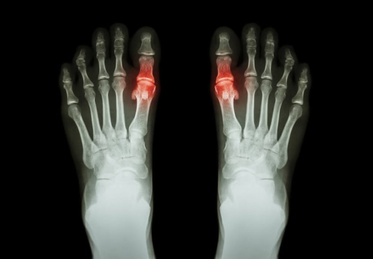 Effective Natural Remedies to Treat Gout