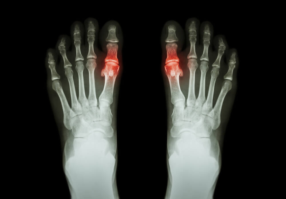 Effective Natural Remedies to Treat Gout