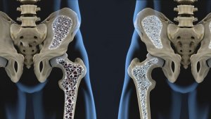 Six Diet Tips to Prevent Osteoporosis