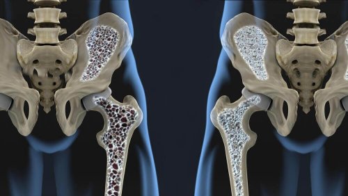 6 Diet Tips to Help You Prevent Osteoporosis