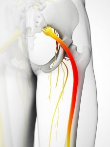 5 Ways to Relieve Sciatica Symptoms
