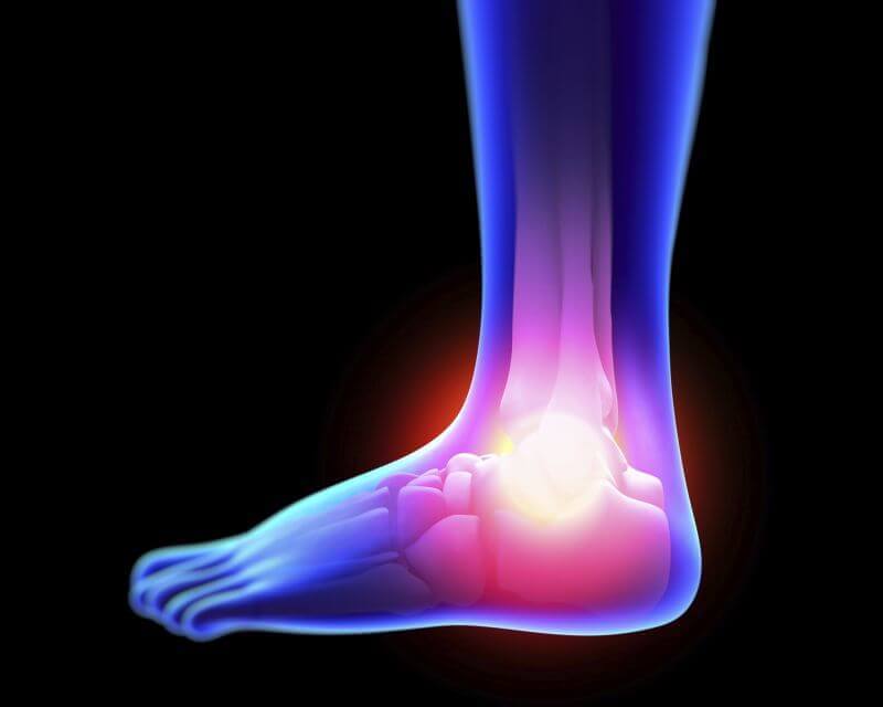 How to Treat Sprain Symptoms Naturally