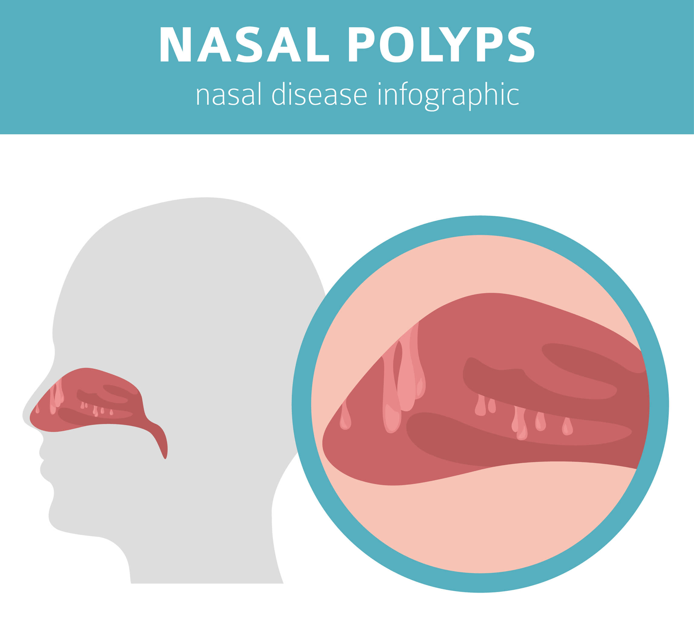 how-to-treat-nasal-polyps-naturally-step-to-health