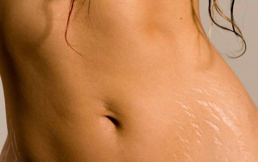 Use alum stone to combat stretch marks.