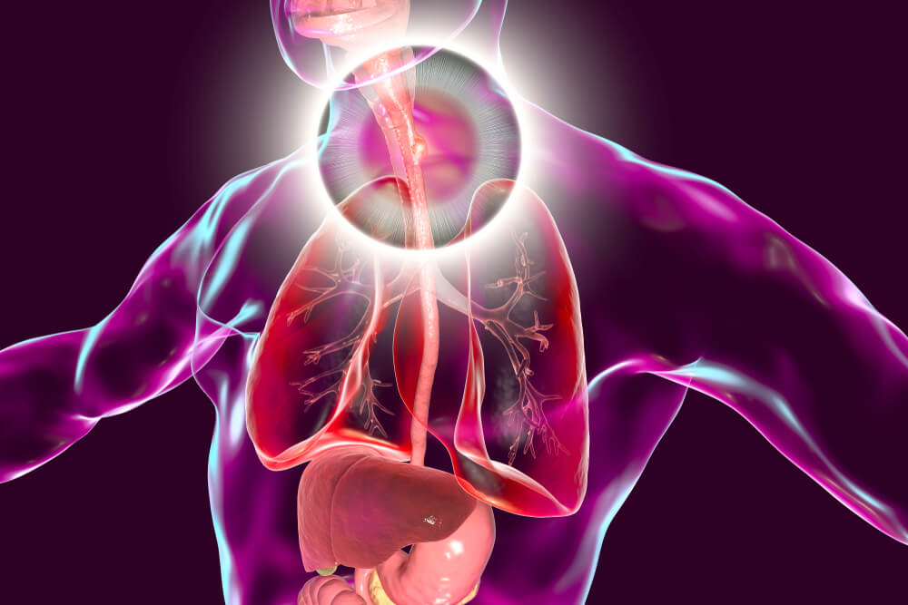 3b-scientific-gastroesophageal-reflux-disease-chart-gerd