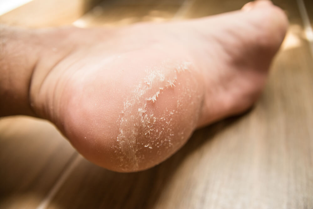 How Do Foot Doctors Remove Calluses