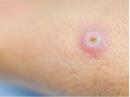 This boil has been picked at