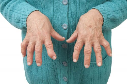 Relieve Rheumatoid Arthritis with Medicinal Remedies