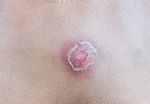 What Are Boils? Seven Tips to Get Rid of Them