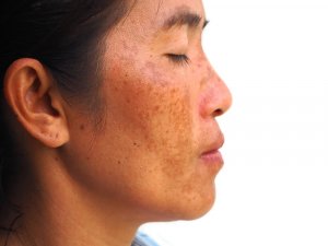 How to Reduce Melasma with Yogurt, Bananas, and Lemons