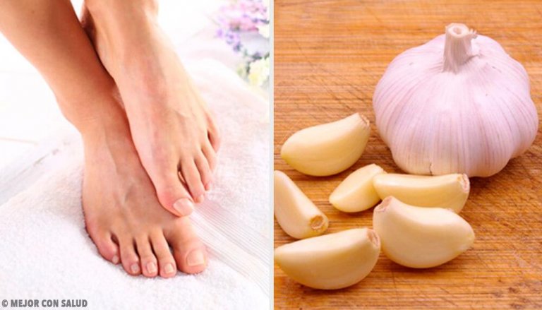 Three Ways to Use Crushed Garlic to Treat Ingrown Toenails