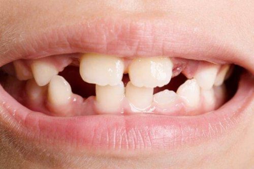 Dental Agenesis: Types and Treatments
