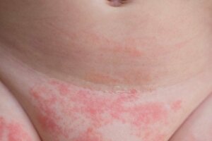 Four Tips to Prevent Diaper Rash