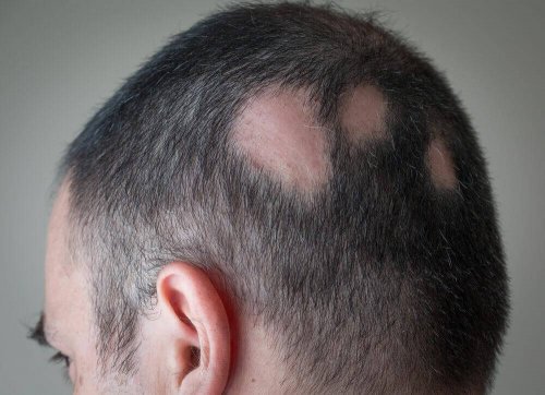 How to treat alopecia