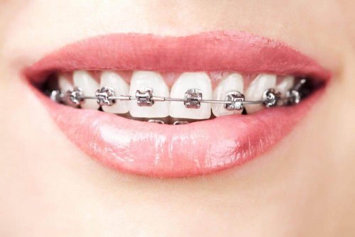 A woman with orthodontics.