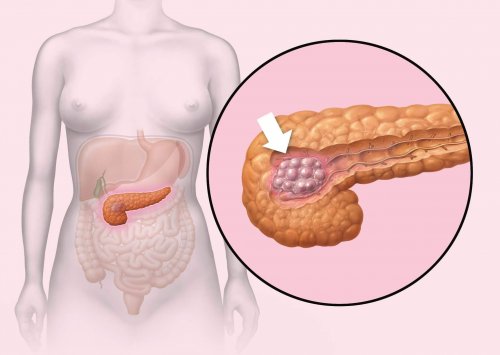 Pankreaskarzinom - Schaubild Bauchspeicheldrüse