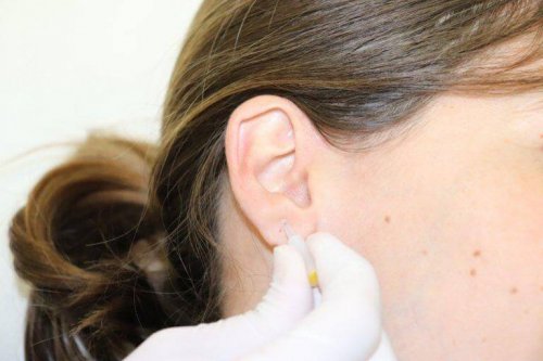A person applying auriculotherapy.