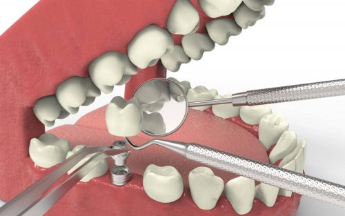 Dental Agenesis