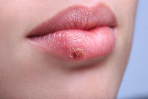 A woman with a cold sore.