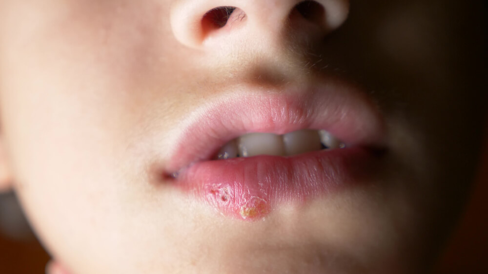 6-remedies-to-combat-cold-sores-in-children-step-to-health
