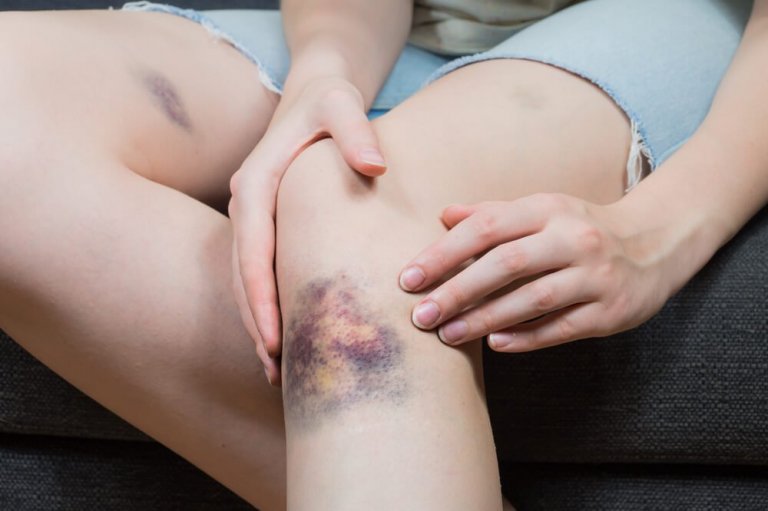 5 Natural Solutions to Treat Bruises