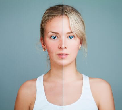 Seven Foods You Should Include in Your Diet to Reduce Rosacea