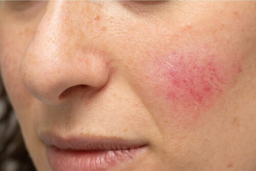 A woman who needs to reduce rosacea.